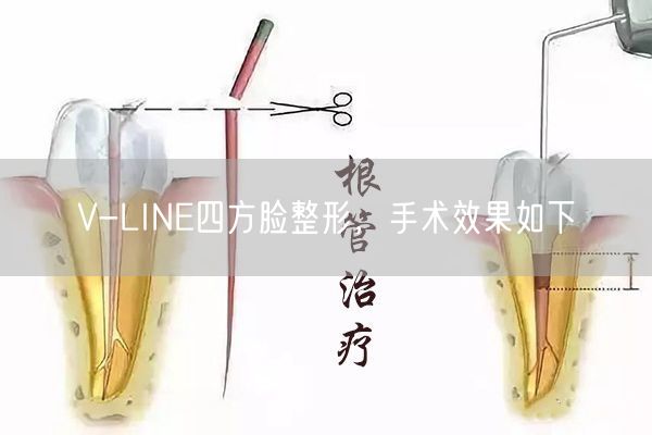V-LINE四方脸整形，手术效果，注意事项