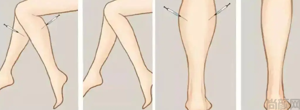 打瘦腿针的危害性,瘦腿针可能会导致不良反应(图1)