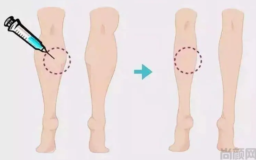 打瘦腿针的危害性,瘦腿针可能会导致不良反应(图2)
