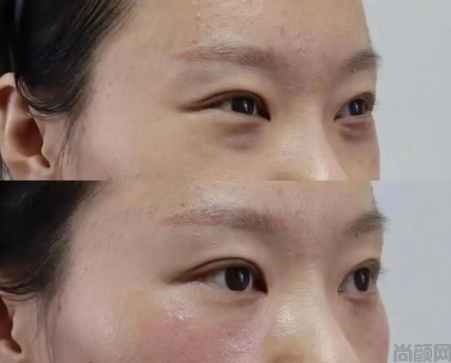 打完泪沟恢复过程图片,手术第一天该注意什么(图1)