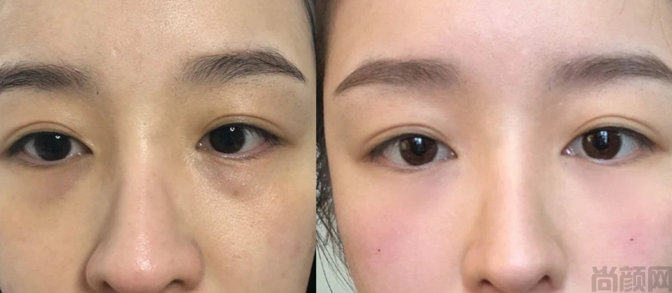 打完泪沟恢复过程图片,手术第一天该注意什么(图3)