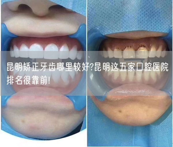 昆明矫正牙齿哪里较好?昆明这五家口腔医院排名很靠前!