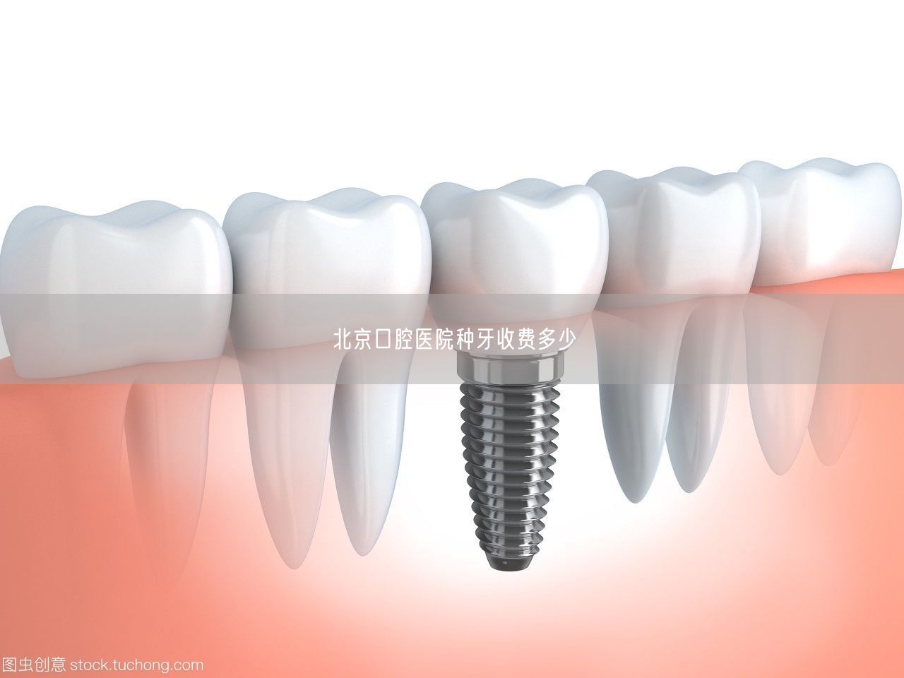 北京口腔医院种牙收费多少