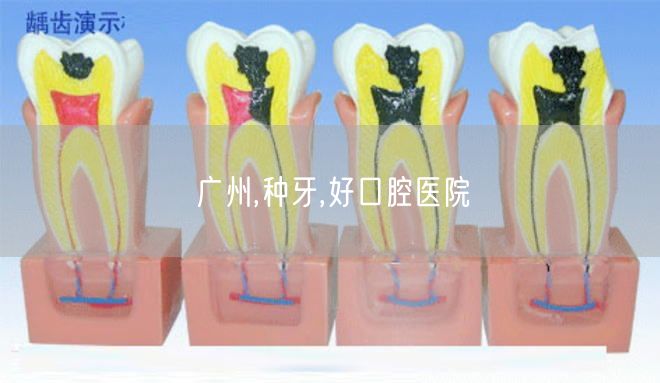 广州,种牙,好口腔医院