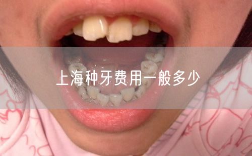 上海种牙费用一般多少