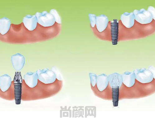 西安团圆口腔种植牙多少钱一颗(图3) 西安团圆口腔种植牙多少钱一颗(图3)