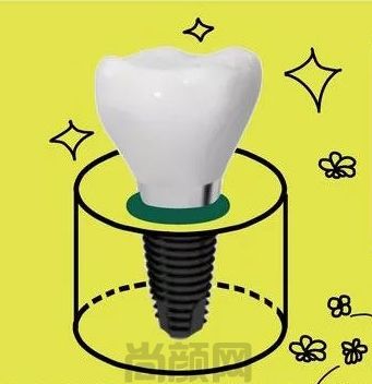 上海薇琳口腔医院种植牙费用更新，集采价格3620起很实惠(图2)