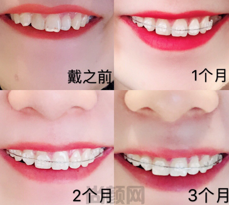 北京陶瓷牙齿矫正价格