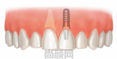 韩国登腾种植牙2500元一颗，性价比可不可信看了便知
