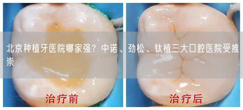 北京种植牙医院哪家强？中诺、劲松、钛植三大口腔医院受推崇