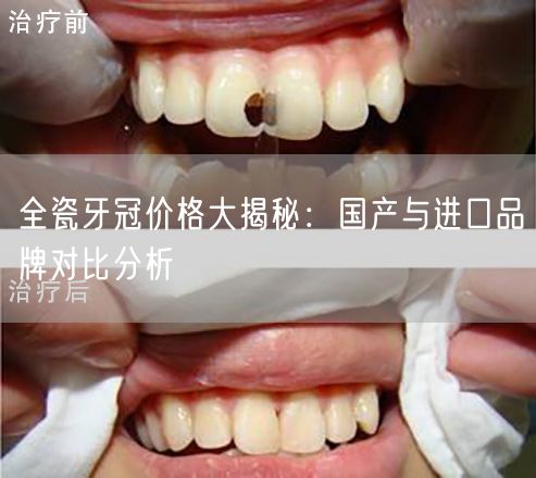 全瓷牙冠价格大揭秘：国产与进口品牌对比分析(图1)