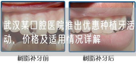 武汉某口腔医院推出优惠种植牙活动，价格及适用情况详解