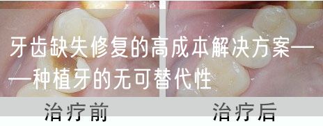 牙齿缺失修复的高成本解决方案——种植牙的无可替代性(图1)