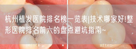 杭州植发医院排名榜一览表|技术哪家好!整形医院排名前六的盘点避坑指南~