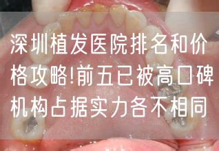 深圳植发医院排名和价格攻略!前五已被高口碑机构占据实力各不相同