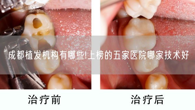 成都植发机构有哪些!上榜的五家医院哪家技术好