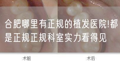 合肥哪里有正规的植发医院!都是正规正规科室实力看得见