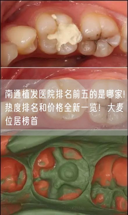 南通植发医院排名前五的是哪家!热度排名和价格全新一览！大麦位居榜首