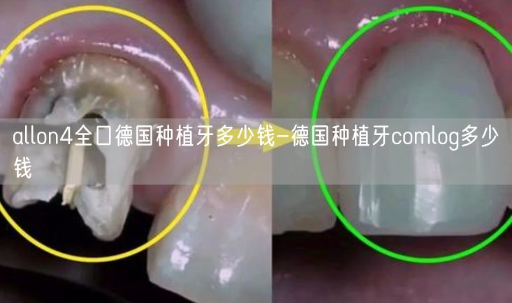 allon4全口德国种植牙多少钱-德国种植牙comlog多少钱