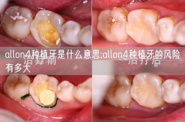 allon4种植牙是什么意思;allon4种植牙的风险有多大