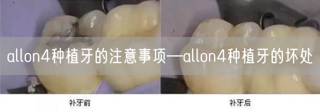 allon4种植牙的注意事项—allon4种植牙的坏处