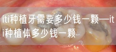 iti种植牙需要多少钱一颗—iti种植体多少钱一颗