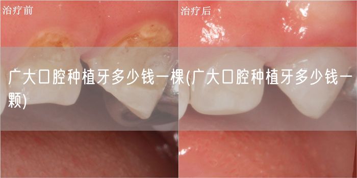 广大口腔种植牙多少钱一棵(广大口腔种植牙多少钱一颗)
