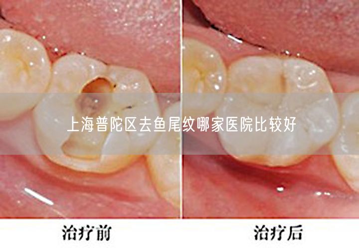 上海普陀区去鱼尾纹哪家医院比较好