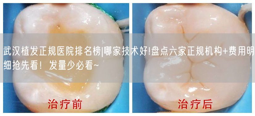 武汉植发正规医院排名榜|哪家技术好!盘点六家正规机构+费用明细抢先看！发量少必看~