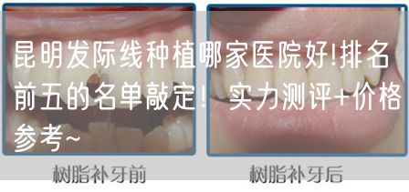 昆明发际线种植哪家医院好!排名前五的名单敲定！实力测评+价格参考~