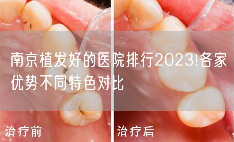 南京植发好的医院排行2023!各家优势不同特色对比
