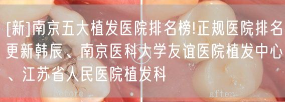 [新]南京五大植发医院排名榜!正规医院排名更新韩辰、南京医科大学友谊医院植发中心、江苏省人民医院植发科