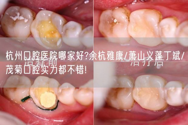 杭州口腔医院哪家好?余杭雅康/萧山义蓬丁斌/茂菊口腔实力都不错!