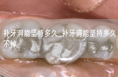 补牙洞能坚持多久_补牙洞能坚持多久不掉(图1)