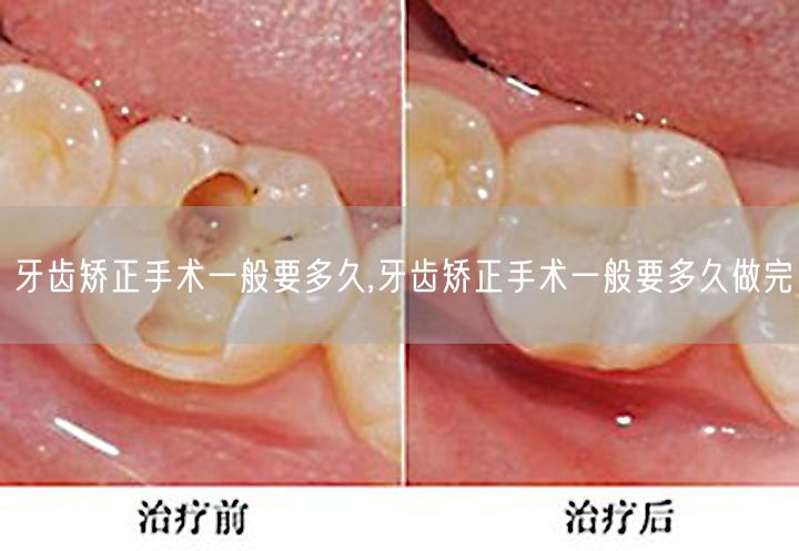 牙齿矫正手术一般要多久,牙齿矫正手术一般要多久做完