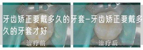 牙齿矫正要戴多久的牙套-牙齿矫正要戴多久的牙套才好(图1)