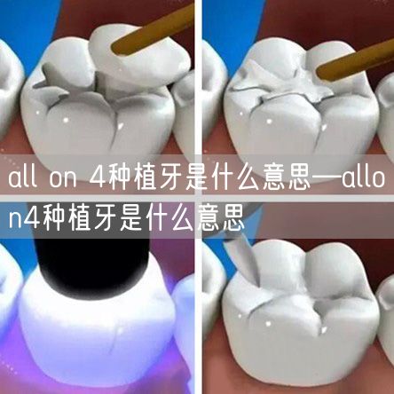 all on 4种植牙是什么意思—allon4种植牙是什么意思
