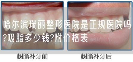 哈尔滨瑞丽整形医院是正规医院吗?吸脂多少钱?附价格表