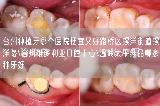 台州种植牙哪个医院便宜又好路桥区螺洋街道螺洋路\台州维多利亚口腔中心\温岭太平维品哪家种牙好
