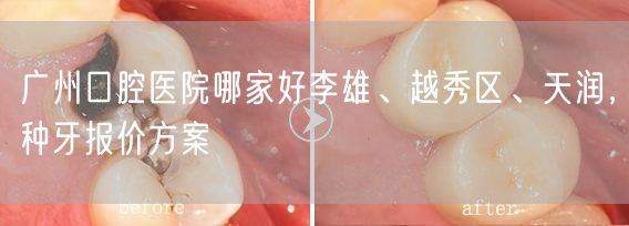 广州口腔医院哪家好李雄、越秀区、天润，种牙报价方案