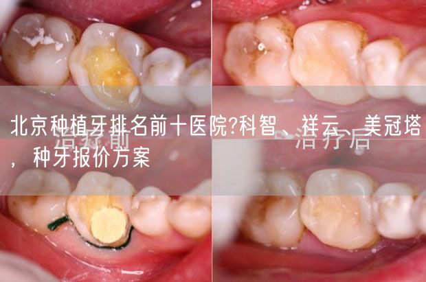北京种植牙排名前十医院?科智、祥云、美冠塔，种牙报价方案