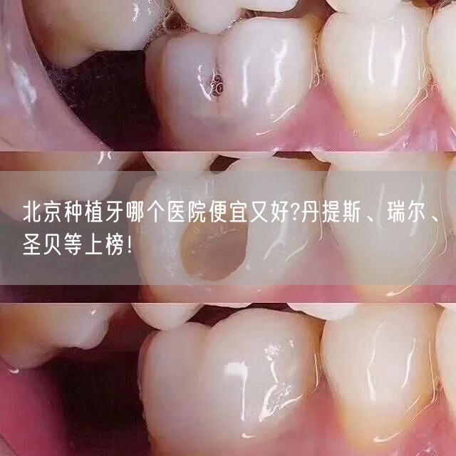 北京种植牙哪个医院便宜又好?丹提斯、瑞尔、圣贝等上榜！
