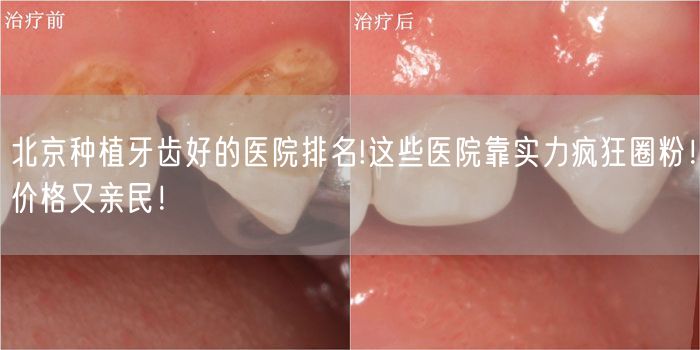 北京种植牙齿好的医院排名!这些医院靠实力疯狂圈粉！价格又亲民！