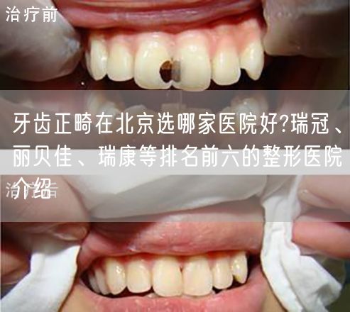 牙齿正畸在北京选哪家医院好?瑞冠、丽贝佳、瑞康等排名前六的整形医院介绍