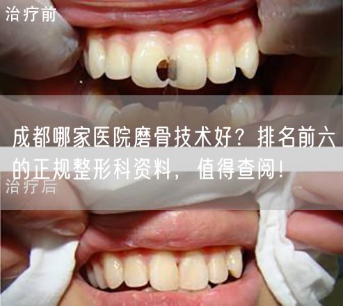 成都哪家医院磨骨技术好？排名前六的正规整形科资料，值得查阅！