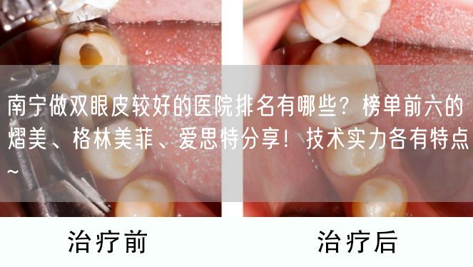 南宁做双眼皮较好的医院排名有哪些？榜单前六的熠美、格林美菲、爱思特分享！技术实力各有特点~