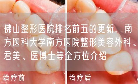 佛山整形医院排名前五的更新，南方医科大学南方医院整形美容外科、君美、医博士等全方位介绍