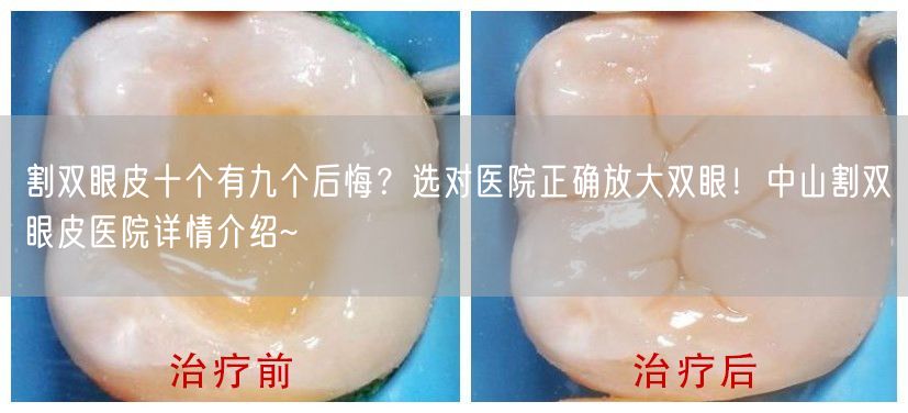 割双眼皮十个有九个后悔？选对医院正确放大双眼！中山割双眼皮医院详情介绍~
