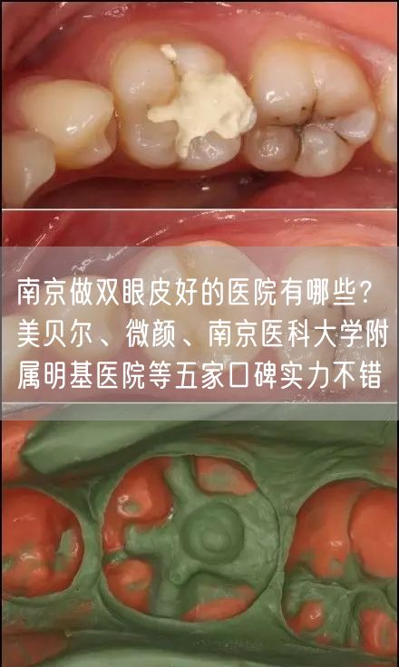 南京做双眼皮好的医院有哪些？美贝尔、微颜、南京医科大学附属明基医院等五家口碑实力不错