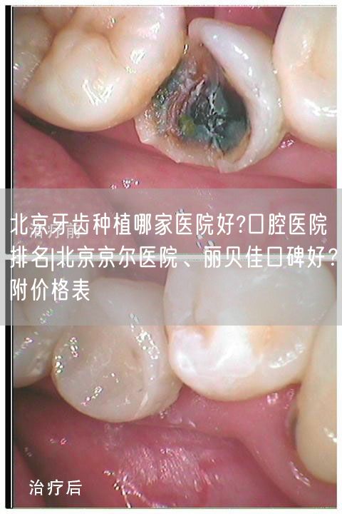 北京牙齿种植哪家医院好?口腔医院排名|北京京尔医院、丽贝佳口碑好？附价格表